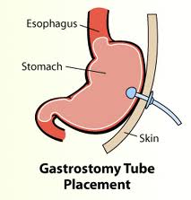 Feeding tube Gastric G tube